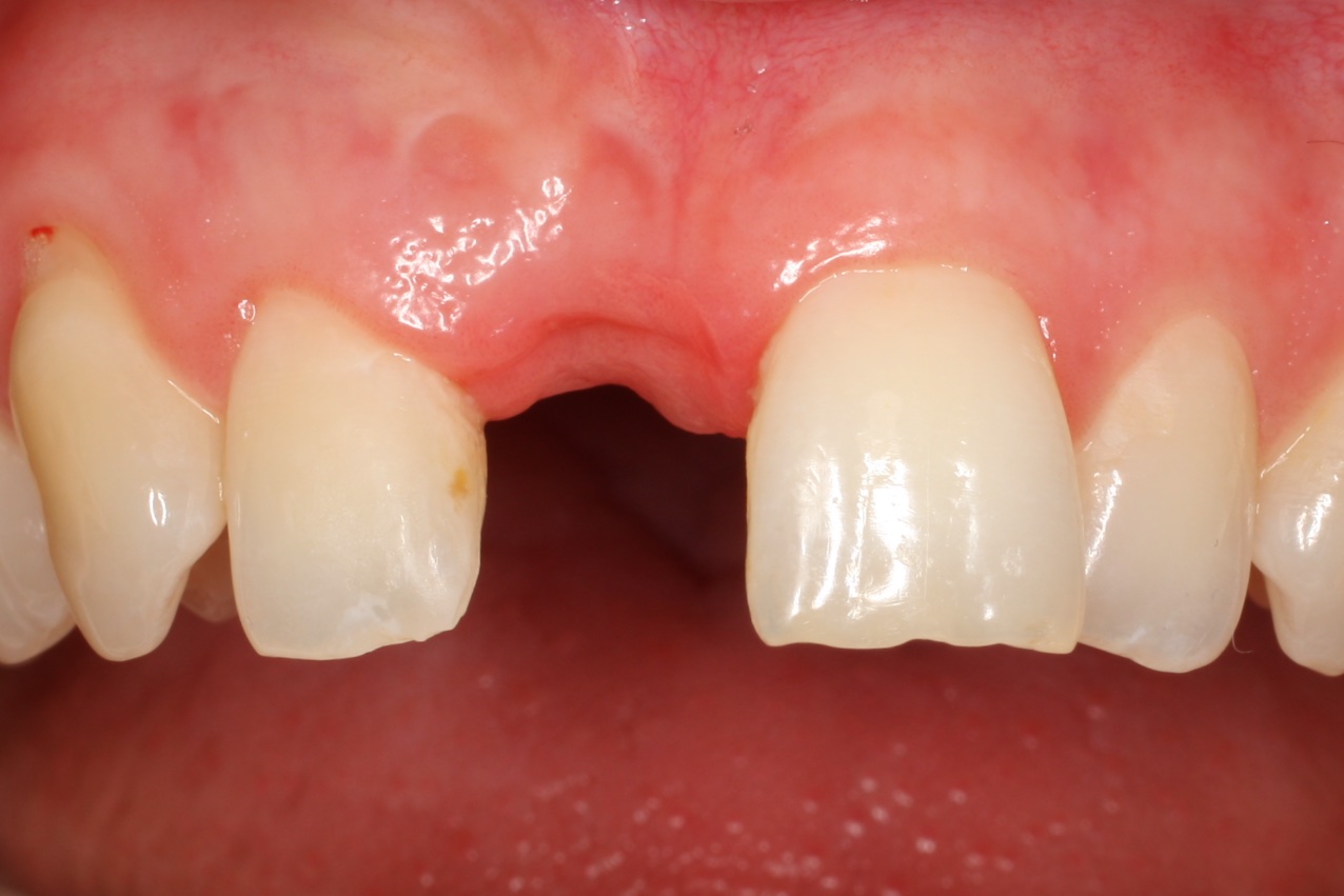 Before-Dental Implant 1 tooth