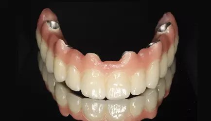 Replace all missing teeth