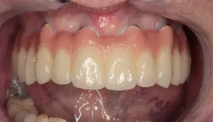 Replace all missing teeth