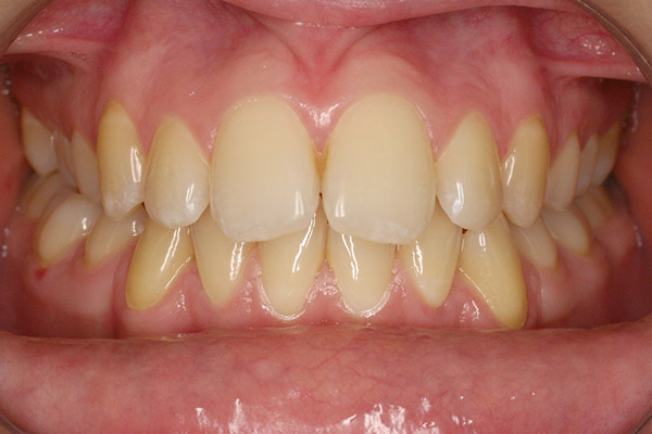 Before-Teeth Whitening