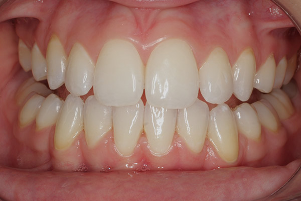 After-Teeth Whitening