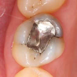 Composite Fillings