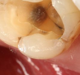 Composite fillings