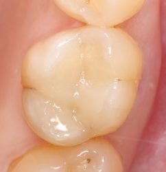 Composite Fillings