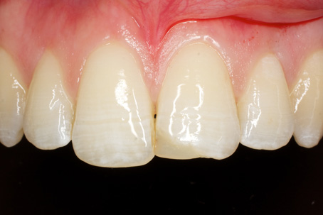 Composite fillings