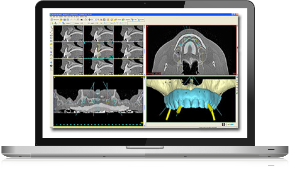 Computer Guided Surgery