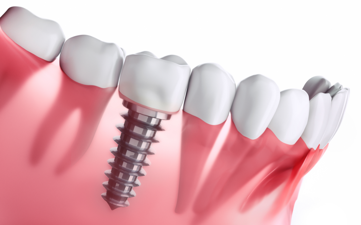 Dental Implants FAQ