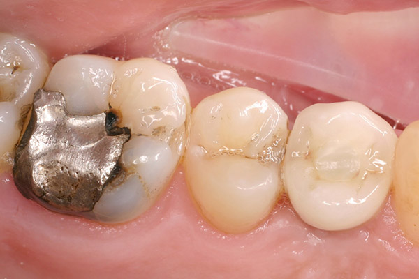 Before-Tooth Inlays 