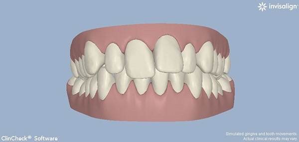 Before-Invisalign Eight a