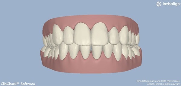 After-Invisalign Eight a