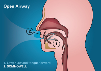 Snoring Solutions & Treatment | Roy Morris Dental Excellence