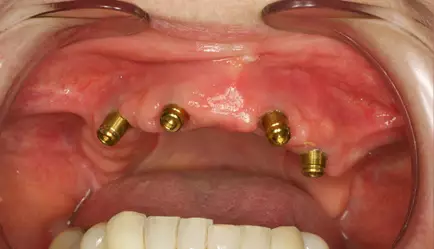 Implants and locaters in place