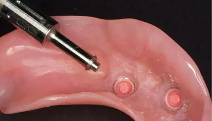 The denture retainers are easily changed should they loosen