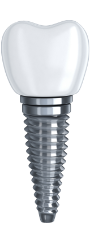 Dental Implant