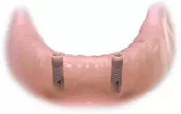 Replace missing teeth