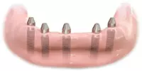 Replace missing teeth