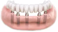 Replace missing teeth