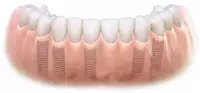 Replace missing teeth