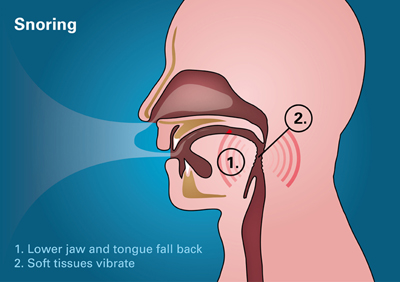 Snoring Treatment | Worcestershire Dental Implants | Roy Morris Dental ...